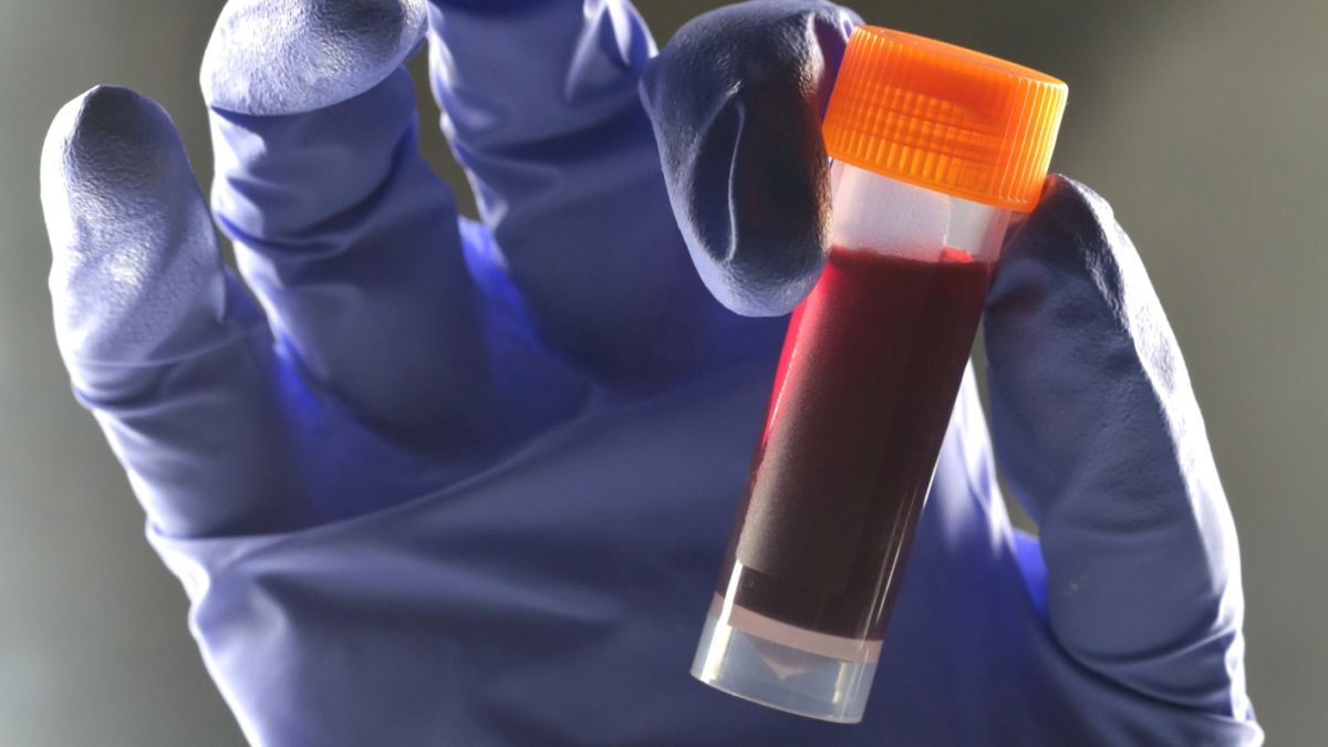 Ši kraujo grupė gali reikšti didesnę 2 tipo diabeto riziką: tyrėjai įvardijo skaičių