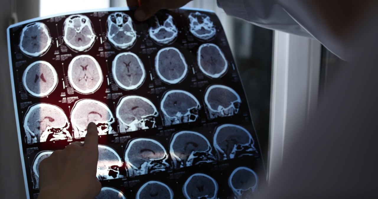 Mokslininkai rado ryšį: daugiau vitamino D vidutiniame amžiuje – mažiau Alzheimerio žymenų
