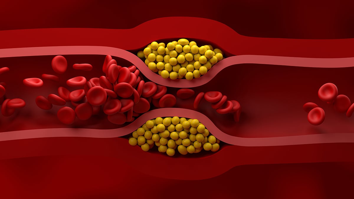 JAV kardiologai paskelbė naujas cholesterolio gaires: ką būtina žinoti, kad apsisaugotumėte