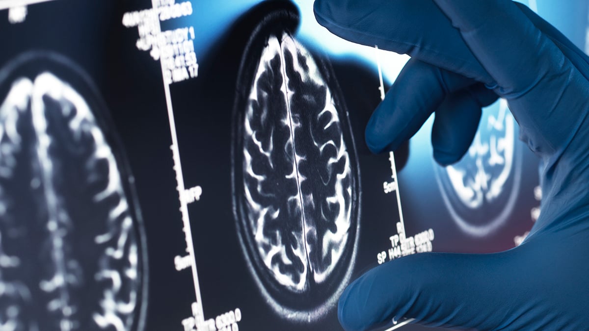 Lūžis ar fiasko? „Cochrane“ peržiūra suabejojo naujais Alzheimerio vaistais