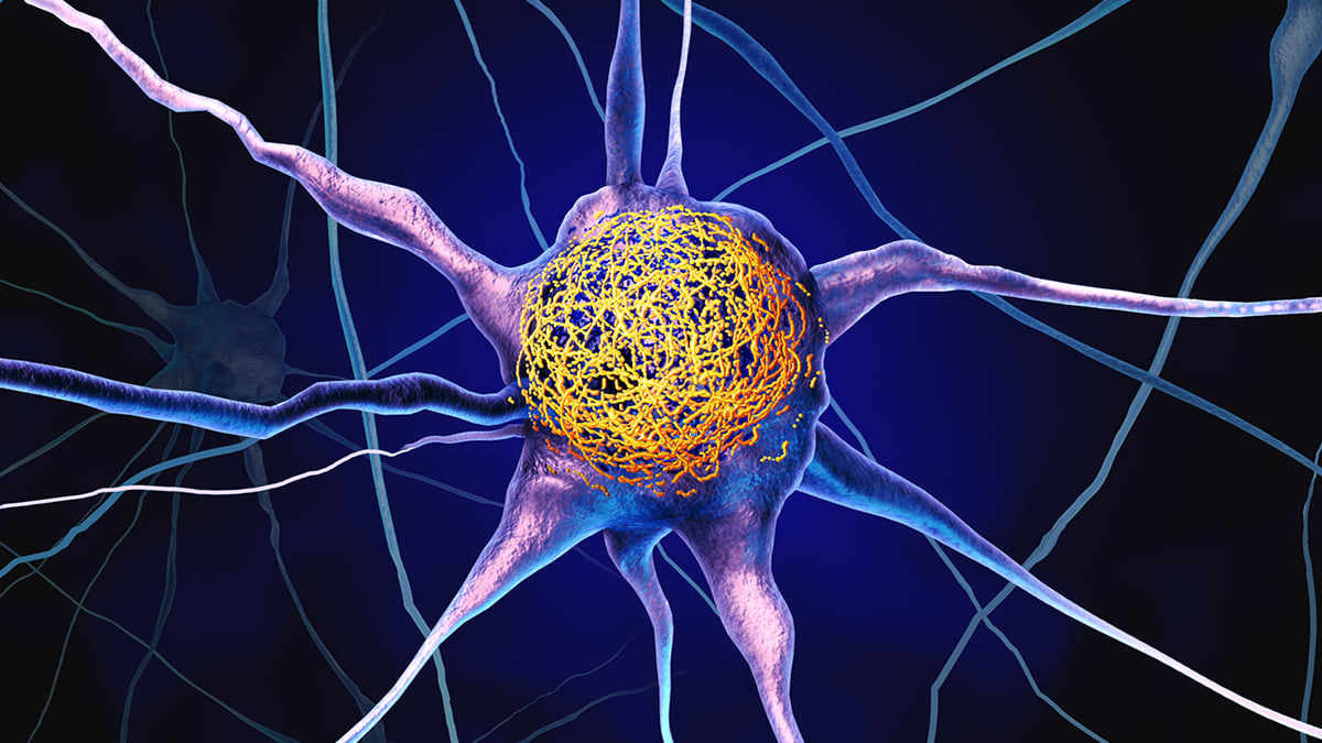 Vitaminas D gali stabdyti Alzheimerio baltymų kaupimąsi: 16 metų tyrimas nustebino