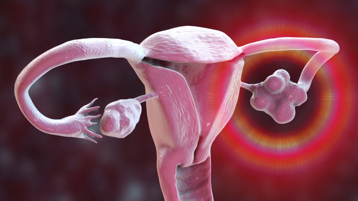 PCOS keičia pavadinimą po dešimtmečių painiavos: kodėl gydytojai nori PMOS ir ką tai pakeis?