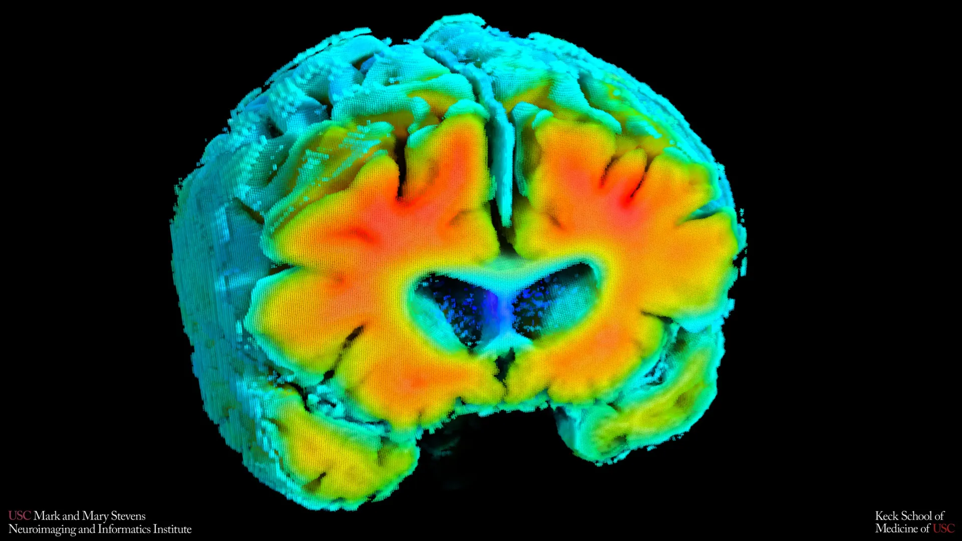 New Alzheimer’s study points to subtle brain blood flow changes as an early warning sign
