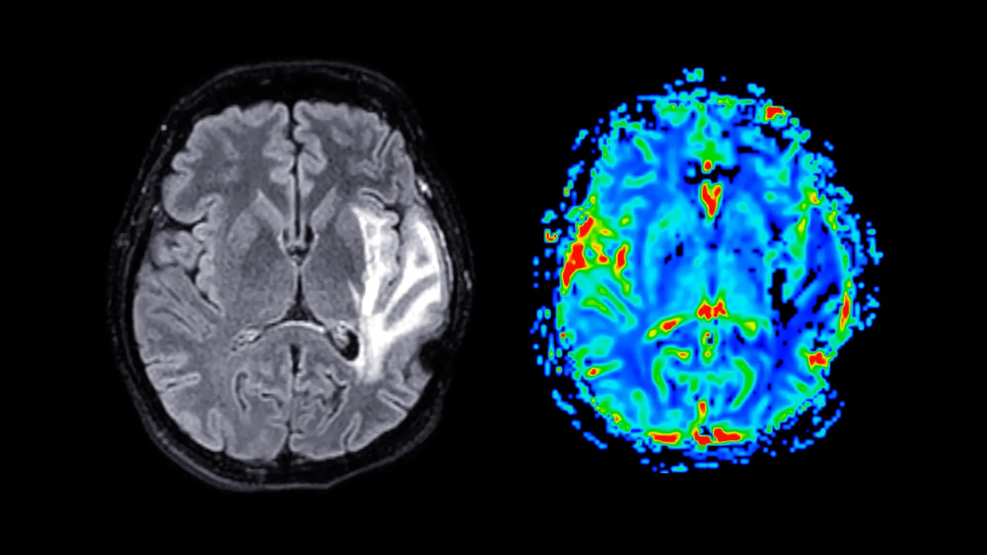 Cambridge study links menopause to grey matter decline, raising new questions about HRT and brain health