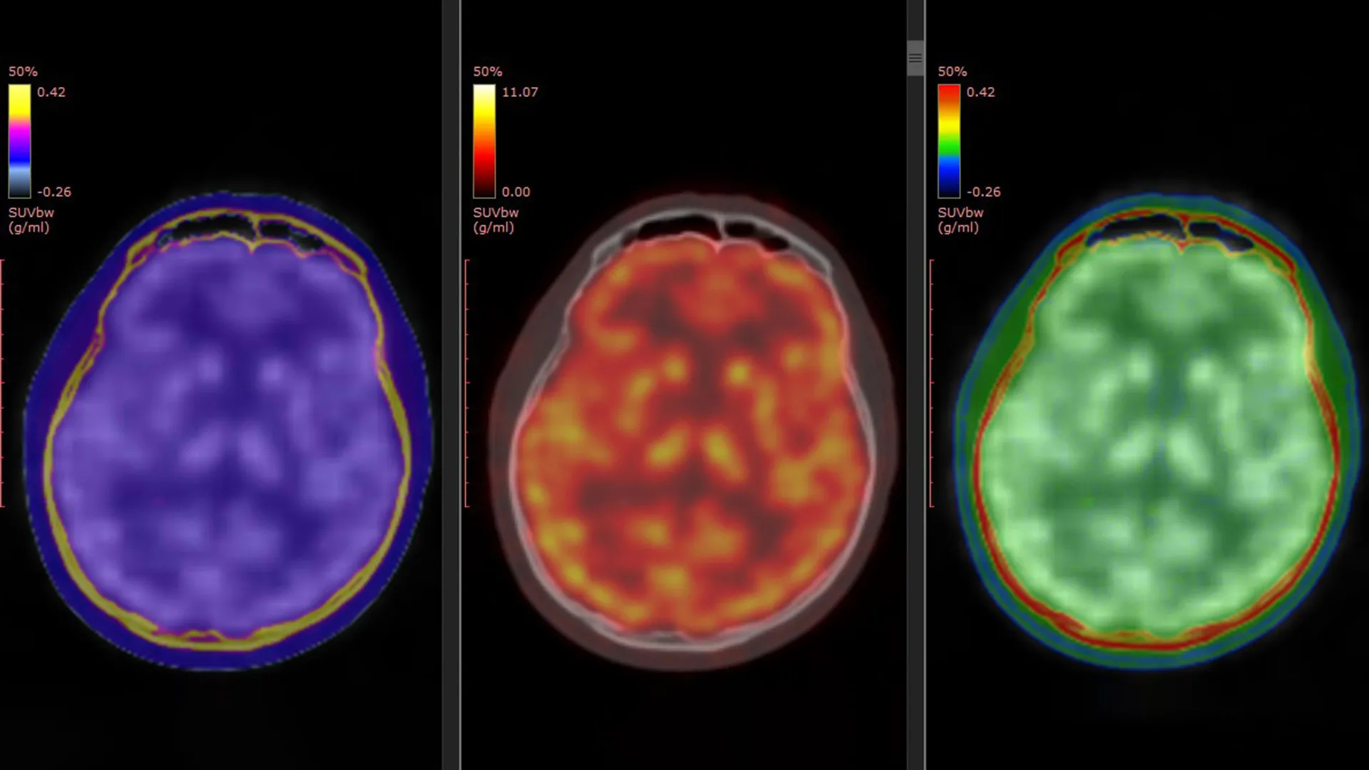 PET brain scans map ketamine’s rapid antidepressant effect, pointing to a potential biomarker for treatment-resistant depression