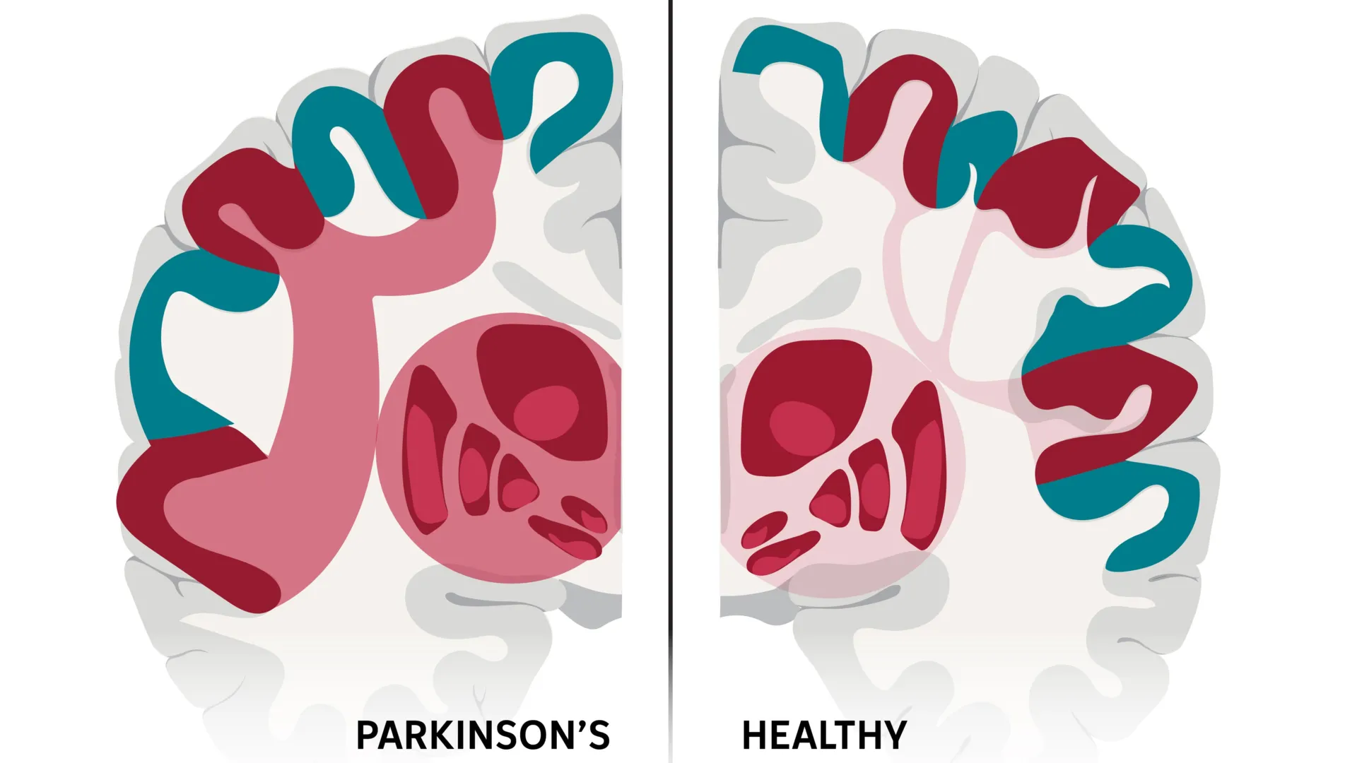 Parkinson’s Study Points to SCAN Brain Network as a New Treatment Target, With Early Gains From Non-Invasive Stimulation