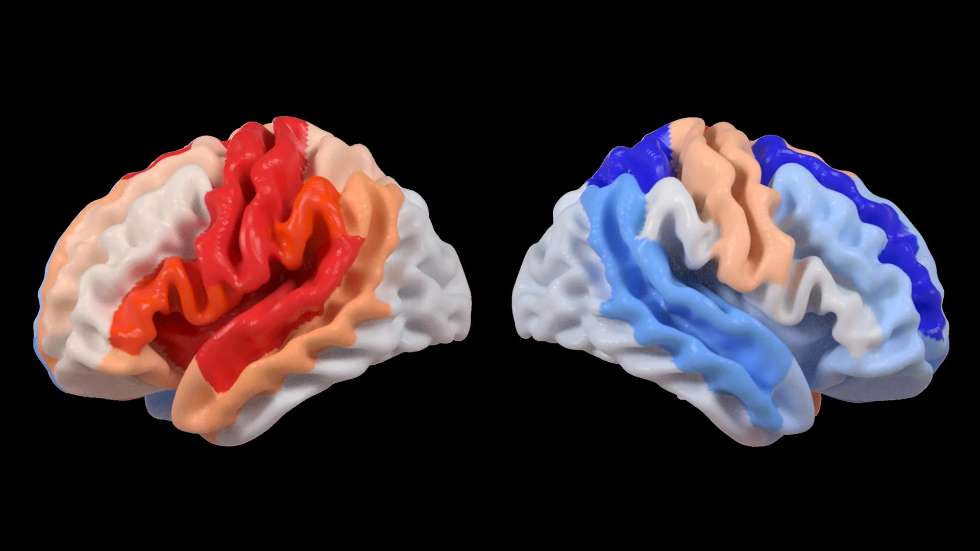 AI study finds stroke may make the opposite brain hemisphere look younger, offering new clues on recovery