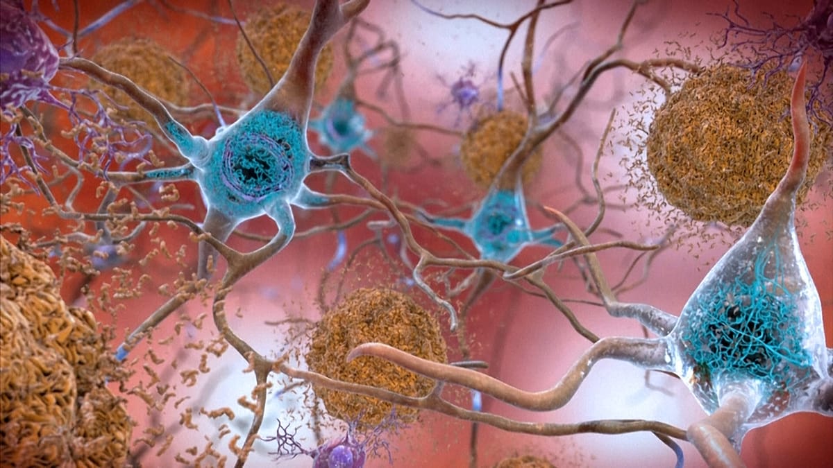 Kraujo tyrimas gali anksti parodyti Alzheimerio riziką: ką iš tiesų rodo amiloidas ir tau
